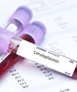 copper overload test elevated copper low ceruloplasmin