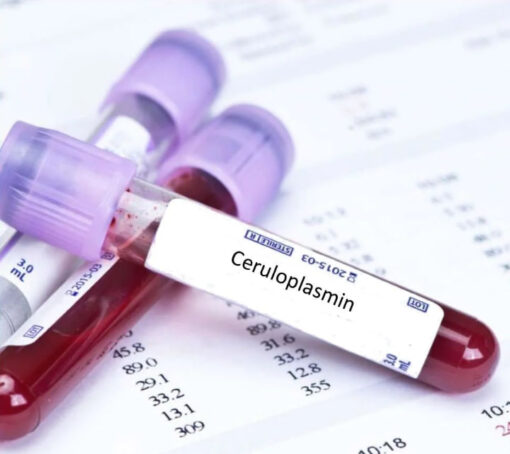 copper overload test elevated copper low ceruloplasmin